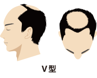 Ⅳ型から進行し、前頭部と頭頂部の薄毛がつながりそうな状態