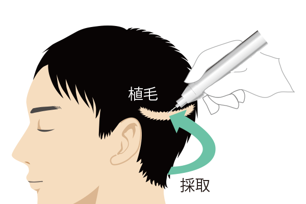 自毛植毛FUSSの傷跡への修正植毛手術のイラスト