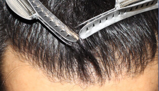 30代 男性 M.Y.さん 生え際・前頭部の自毛植毛（MIRAI法） 2,000株の症例（施術後）