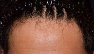 30代 男性 S.D.さん 生え際・頭頂部の自毛植毛（MIRAI法） 1,700株の症例（施術前）