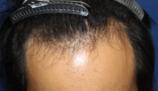 30代 男性 Y.T.さん 生え際の自毛植毛（MIRAI法） 2,300株の症例（施術前）
