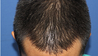 30代 男性 Y.T.さん 前頭部の自毛植毛（MIRAI法） 1,600株の症例（施術後）