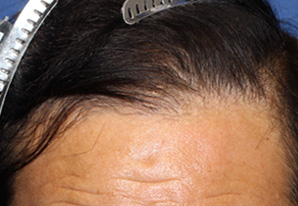 60代 男性 F.S.さん 生え際の自毛植毛（MIRAI法） 1,600株｜自毛植毛の症例（10ヶ月後）