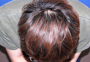 30代 男性 H.Y.さん 頭頂部の自毛植毛（MIRAI法） 2,700株の症例（12ヶ月後）