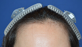 40代 女性 O.K.さん 生え際・前頭部の自毛植毛（NC-MIRAI法） 1,600株の症例（施術前）