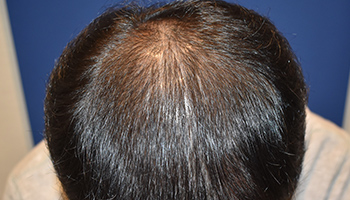 50代 男性 F.K.さん  生え際・頭頂部 自毛植毛（MIRAI法） 1,600株の症例（施術後）