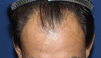 40代 男性 D.S.さん　生え際 自毛植毛（MIRAI法） 2,000株の症例（施術前）