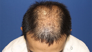 30代 男性 I.Y.さん　前頭部・頭頂部・つむじ 自毛植毛（MIRAI法） 2,500株の症例（施術前）
