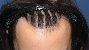 	30代 男性 N.N.さん　生え際 自毛植毛（NC-MIRAI法） 2,000株の症例（施術後）