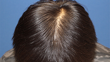 30代 男性 K.M.さん　生え際・頭頂部 自毛植毛（MIRAI法） 1,500株の症例（施術後）