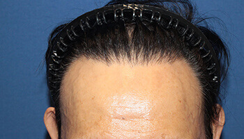 50代 男性 H.A.さん 生え際・前頭部の自毛植毛（NC-MIRAI法） 2,800株の症例（施術後）