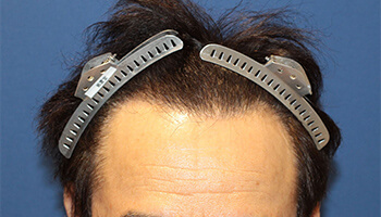 60代 男性 S.H.さん　生え際・前頭部 自毛植毛（NC-MIRAI法） 2,500株の症例（施術後）