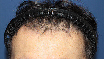 40代 男性 Y.Y.さん 生え際の自毛植毛（NC-MIRAI法） 1,200株の症例（施術後）