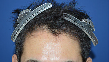 40代 男性 N.J.さん　生え際・前頭部 自毛植毛（MIRAI法） 1,400株の症例（施術後）