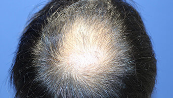 30代 男性 W.T.さん　頭頂部 自毛植毛（MIRAI法） 2,000株の症例（施術前）