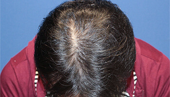 30代 男性 I.H.さん　生え際・頭頂部 自毛植毛（MIRAI法） 1,200株の症例（施術後）