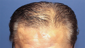 60代 男性 A.M.さん　生え際・頭頂部 自毛植毛（MIRAI法） 2,000株の症例（施術前）