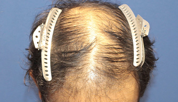 60代 男性 O.Y.さん  生え際・前頭部・頭頂部 自毛植毛（MIRAI法） 3,000株の症例（施術前）