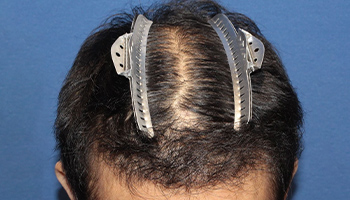60代 男性 O.Y.さん  生え際・前頭部・頭頂部 自毛植毛（MIRAI法） 3,000株の症例（施術後）