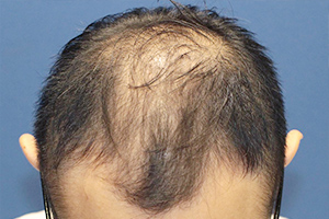 30代 男性 K.S.さん  前頭部 自毛植毛（MIRAI法） 2,500株の症例（施術前）