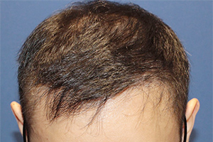 30代 男性 K.S.さん  前頭部 自毛植毛（MIRAI法） 2,500株の症例（施術後）
