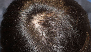 30代 男性 N.T.さん  生え際・頭頂部 自毛植毛（MIRAI法） 1,500株の症例（施術後）