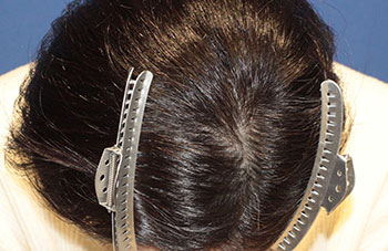 40代 女性 K.Y.さん  生え際 頭頂部 自毛植毛（MIRAI法） 1,000株（手術後）_02