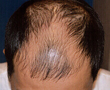 頭頂部の自毛植毛症例写真 30代男性 2,200株 治療前