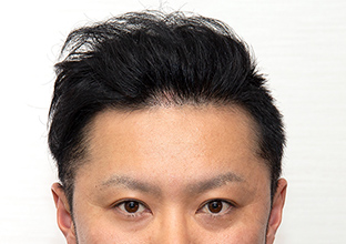 1 Year After Treatment