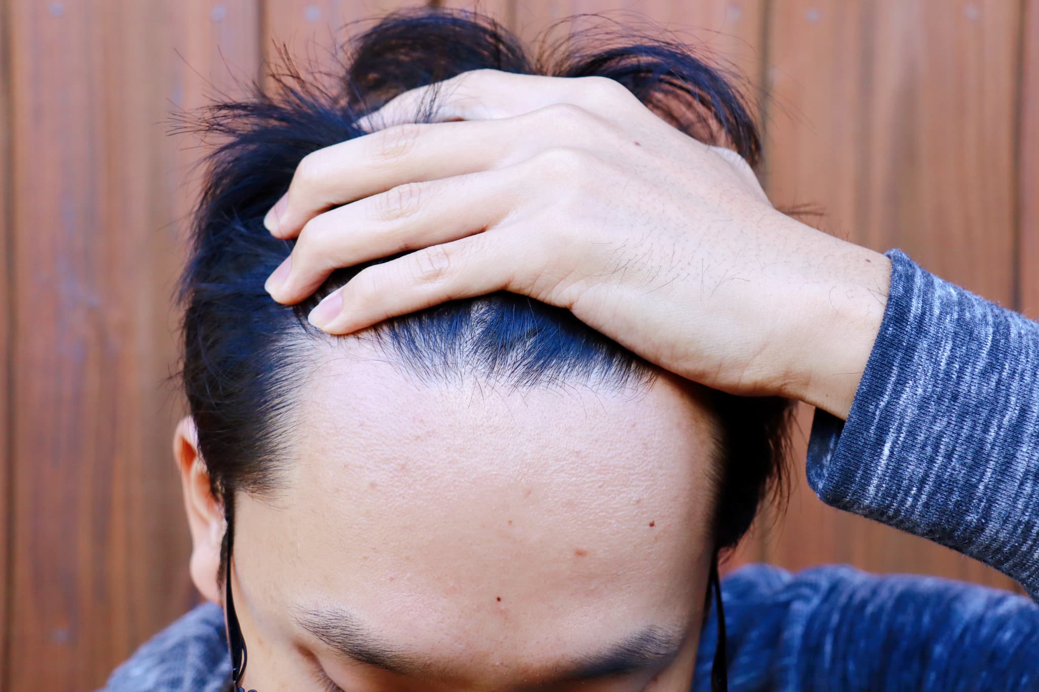 生まれつき（富士額）