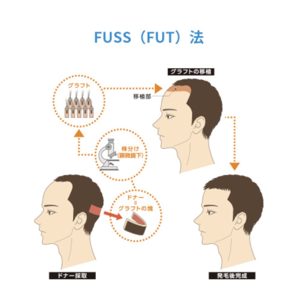 FUSS（FUT）法による植毛の流れを示したイラスト（ドナー採取・株分け・移植・発毛後の状態）