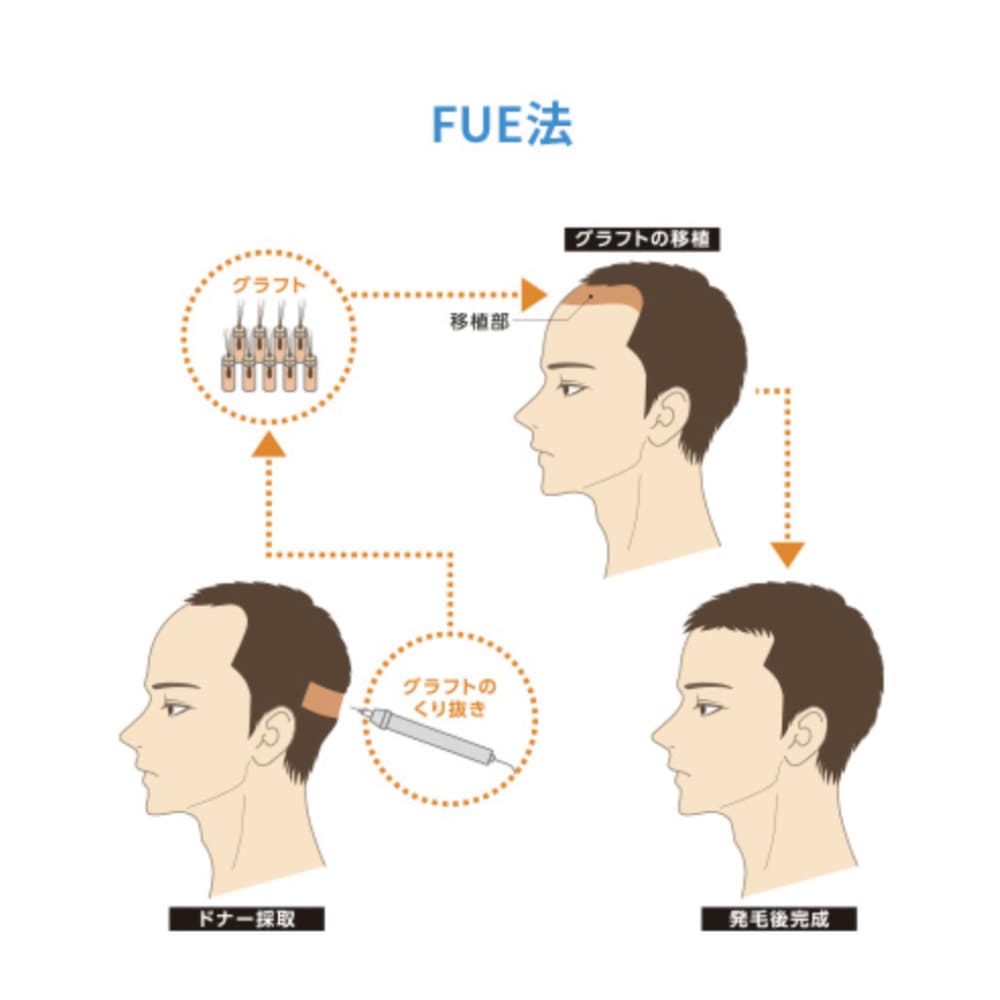 FUE法による植毛の流れを示したイラスト（グラフト採取・移植・発毛後の状態）