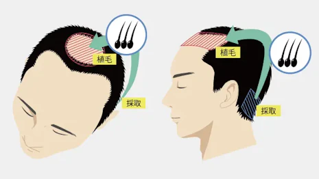 1回の治療で完了できる自毛植毛とは？