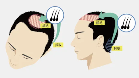 1回の治療で完了できる自毛植毛とは?