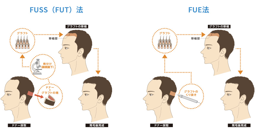 FUSS法とFUE法