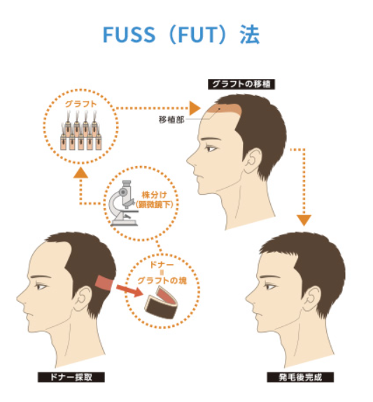 FUSS（FUT）法