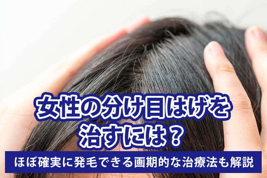 女性の分け目はげを治すには?原因と対策、ほぼ確実に発毛できる画期的な治療法も解説