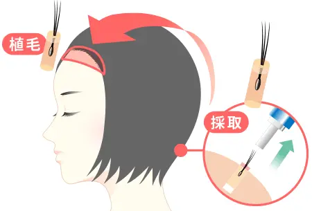 自毛植毛とは