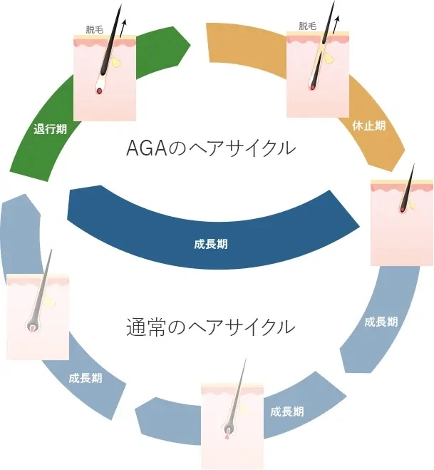 AGAのサイクル