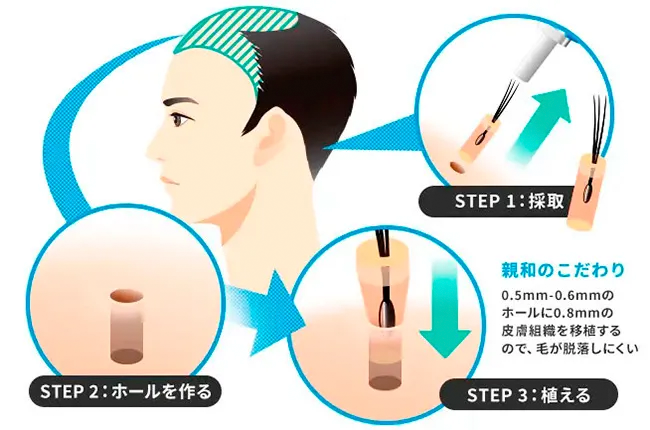 AGA治療の切り札!自毛植毛とは?