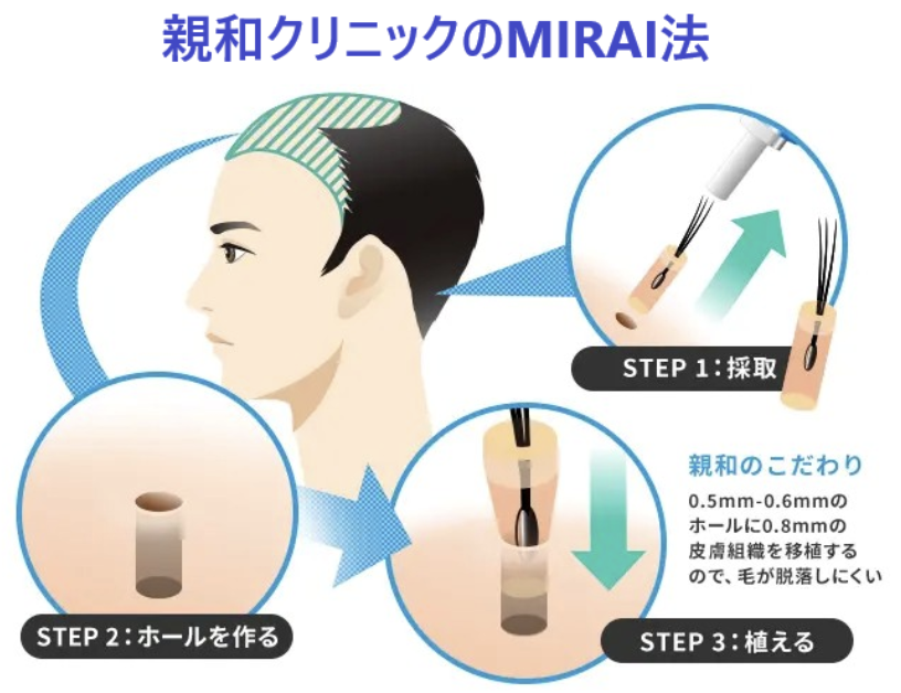 親和クリニックのMIRAI法