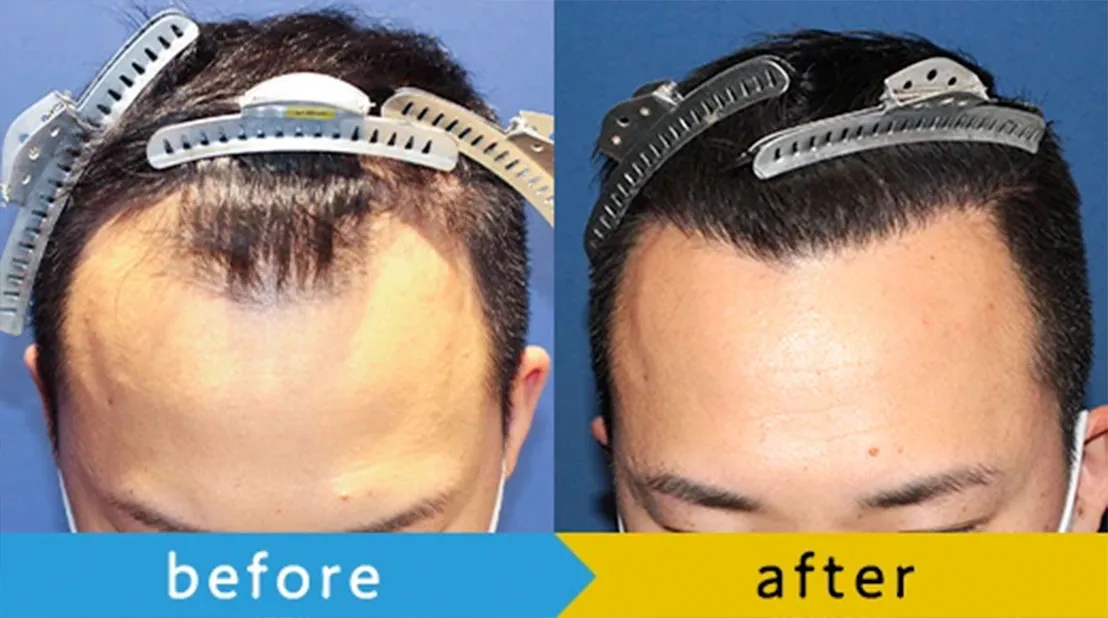 生え際のBefore&After