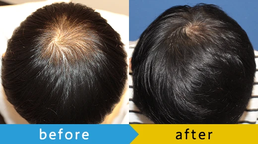 つむじのBefore&After