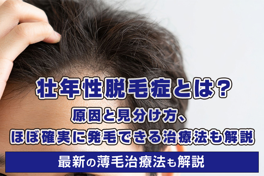 壮年性脱毛症とは？原因と見分け方、ほぼ確実に発毛できる治療法も解説