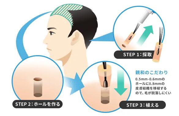 自毛植毛とは？