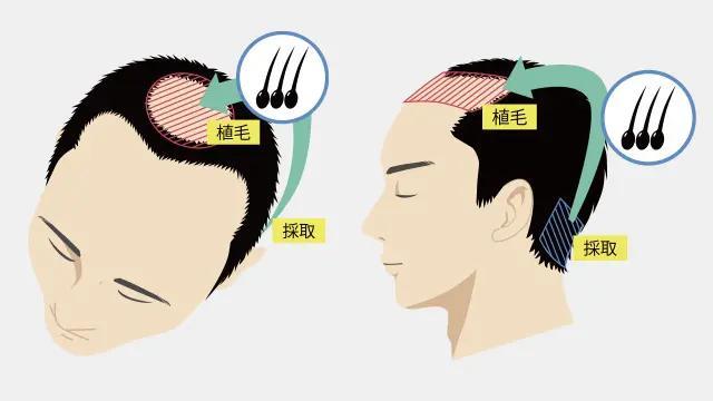 自毛植毛