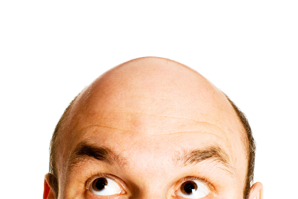 頭頂部はげの見分け方と原因