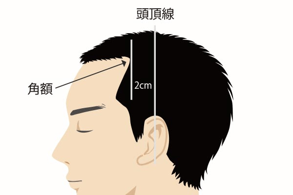 自毛植毛の株数 グラフト数 とは 理想の髪型に必要な株数の決め方 植毛技術の発展と進化した親和クリニックの薄毛治療