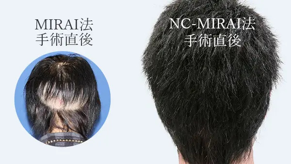 刈り上げない自毛植毛「NC-MIRAI法」も選択可能