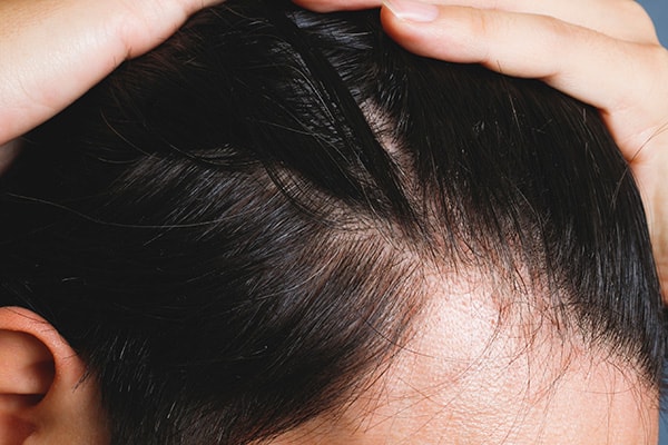 薄毛治療で生え際に産毛が？太く丈夫な髪に育つまでの流れとは
